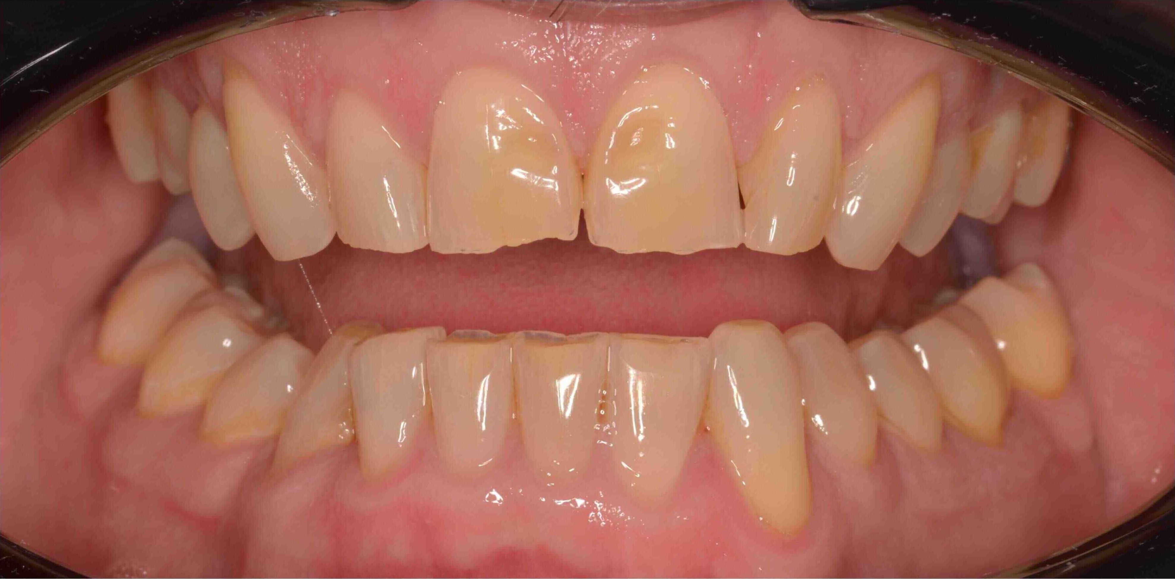 Invisalign and whitening transformation